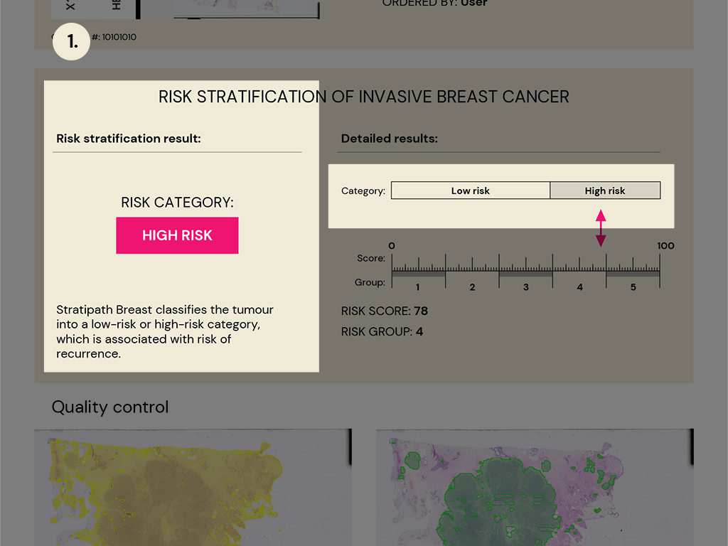 1. Risk category: The tumour is classified into a low-risk or high-risk category, which is associated with risk of recurrence.